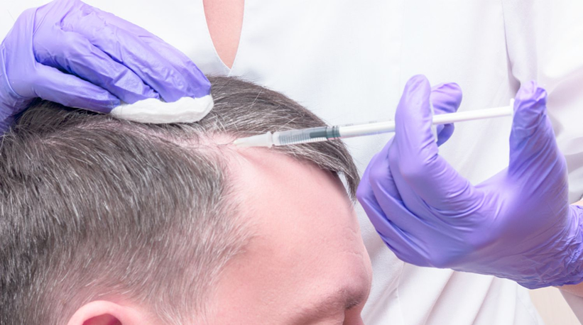 Tratamientos con plasma rico en plaquetas para la caída del cabello